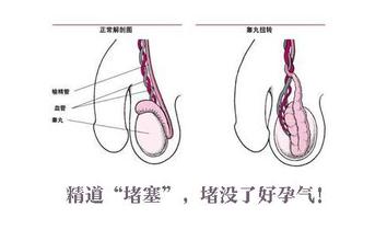 输精管堵塞的原因是什么?来东吴为您揪出病因