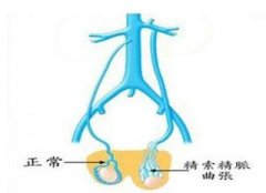 如何治疗精索静脉曲张